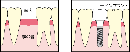 インプラントの特徴イラスト