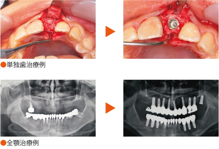 インプラントの治療例
